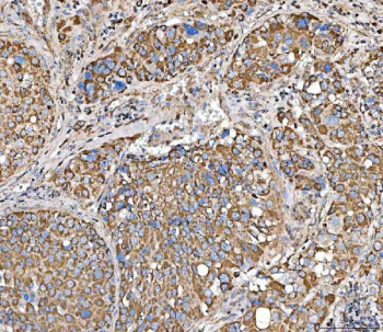 Immunohistochemical staining of FFPE human liver cancer tissue with SUCLG2 antibody, HRP-secondary and DAB substrate. HIER: boil tissue sections in pH8 EDTA for 20 min and allow to cool before testing.