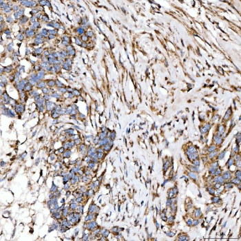 Immunohistochemical staining of FFPE human ovarian serous adenocarcinoma tissue with SUCLG2 antibody, HRP-secondary and DAB substrate. HIER: boil tissue sections in pH8 EDTA for 20 min and allow to cool before testing.