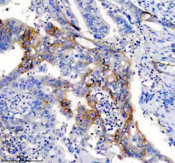 Immunohistochemical staining of FFPE human colon cancer tissue with NCAM-L1 antibody, HRP-secondary and DAB substrate. HIER: boil tissue sections in pH8 EDTA for 20 min and allow to cool before testing.