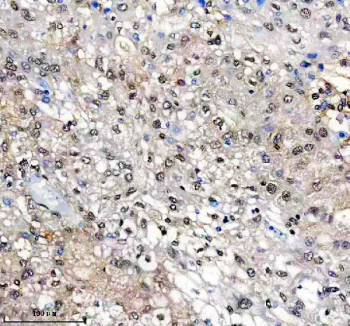 Immunohistochemical staining of FFPE human liver cancer tissue with SUOX antibody, HRP-secondary and DAB substrate. HIER: boil tissue sections in pH8 EDTA for 20 min and allow to cool before testing.