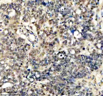 Immunohistochemical staining of FFPE human ovarian cancer tissue with FTO antibody, HRP-secondary and DAB substrate. HIER: boil tissue sections in pH8 EDTA for 20 min and allow to cool before testing.