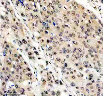 Immunohistochemical staining of FFPE human esophagus cancer tissue with FTO antibody, HRP-secondary and DAB substrate. HIER: boil tissue sections in pH8 EDTA for 20 min and allow to cool before testing.