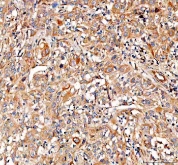Immunohistochemical staining of FFPE human invasive urothelial carcinoma tissue with PKP3 antibody, HRP-secondary and DAB substrate. HIER: boil tissue sections in pH8 EDTA for 20 min and allow to cool before testing.