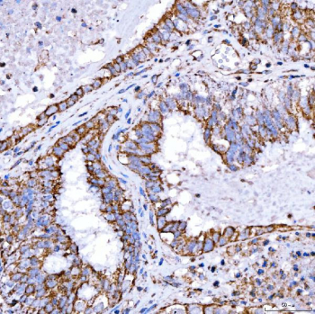 Immunohistochemical staining of FFPE human endometrioid adenocarcinoma tissue with RAB7A antibody, HRP-secondary and DAB substrate. HIER: boil tissue sections in pH8 EDTA for 20 min and allow to cool before testing.