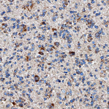 Immunohistochemical staining of FFPE human glioblastoma tissue with RAB7A antibody, HRP-secondary and DAB substrate. HIER: boil tissue sections in pH8 EDTA for 20 min and allow to cool before testing.