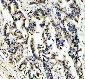 Immunohistochemical staining of FFPE human pancreas cancer tissue using HIV Tat-specific factor 1 antibody, HRP-secondary and DAB substrate. HIER: boil tissue sections in pH8 EDTA for 20 min and allow to cool before testing.