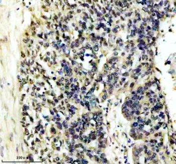 Immunohistochemical staining of FFPE human ovarian cancer tissue using HIV Tat-specific factor 1 antibody, HRP-secondary and DAB substrate. HIER: boil tissue sections in pH8 EDTA for 20 min and allow to cool before testing.