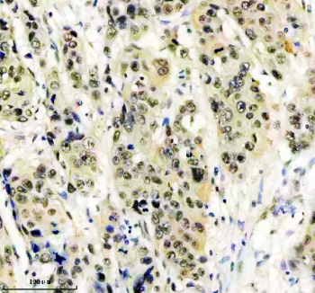Immunohistochemical staining of FFPE human esophageal cancer tissue using HIV Tat-specific factor 1 antibody, HRP-secondary and DAB substrate. HIER: boil tissue sections in pH8 EDTA for 20 min and allow to cool before testing.