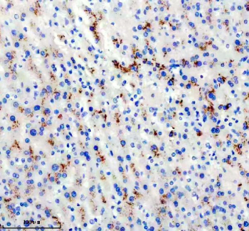 Immunohistochemical staining using DKK3 antibody on paraffin-embedded human liver cancer tissue sections. Heat-induced epitope retrieval was performed using EDTA buffer (pH 8.0) prior to antibody incubation. Sections were blocked with 10% goat serum and incubated with DKK3 antibody overnight at 4C. Detection was carried out using an HRP-based secondary antibody with DAB as the chromogen. Staining shows cytoplasmic immunoreactivity in tumor cells. Nuclei were counterstained with hematoxylin.