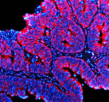 Immunofluorescent staining of FFPE human colon cancer tissue with TTF2 antibody (red) and DAPI nuclear stain (blue). HIER: steam section in pH8 EDTA buffer for 20 min.