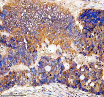 Immunohistochemical staining of FFPE human colon cancer tissue with TTF2 antibody, HRP-secondary and DAB substrate. HIER: boil tissue sections in pH8 EDTA for 20 min and allow to cool before testing.