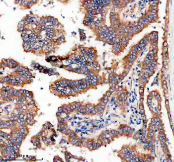 Immunohistochemical staining of FFPE human lung cancer tissue with TTF2 antibody, HRP-secondary and DAB substrate. HIER: boil tissue sections in pH8 EDTA for 20 min and allow to cool before testing.