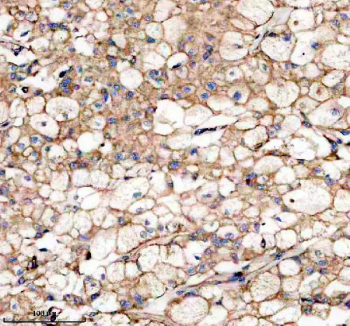 Immunohistochemistry analysis of Indian hedgehog protein using IHH antibody. Indian hedgehog protein expression was examined in a paraffin-embedded section of human liver cancer tissue. Heat-mediated antigen retrieval was performed using EDTA buffer (pH 8.0). Tissue sections were blocked with normal goat serum and incubated with IHH antibody overnight at 4Â°C. Signal was detected using an HRP-based detection system with DAB chromogen, followed by hematoxylin counterstaining.