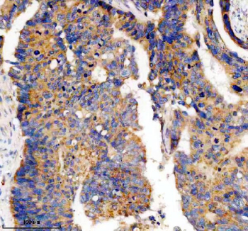 Immunohistochemistry analysis of Phosphodiesterase 4A using PDE4A antibody. Phosphodiesterase 4A expression was examined in a paraffin-embedded section of human colon cancer tissue. Heat-mediated antigen retrieval was performed using EDTA buffer (pH 8.0). Tissue sections were blocked with normal goat serum and incubated with PDE4A antibody overnight at 4Â°C. Immunoreactivity was visualized using an HRP-based detection system with DAB chromogen, followed by hematoxylin counterstaining.