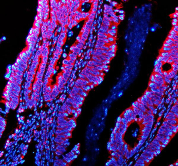 Immunofluorescence analysis of Phosphodiesterase 4A using PDE4A antibody. Phosphodiesterase 4A expression was examined in a paraffin-embedded section of human colon cancer tissue. Heat-mediated antigen retrieval was performed using EDTA buffer (pH 8.0). Tissue sections were blocked with normal goat serum and incubated with PDE4A antibody overnight at 4Â°C. Detection was performed using a fluorescently labeled secondary antibody, and nuclei were counterstained with DAPI. Fluorescent images were acquired using appropriate filter sets.