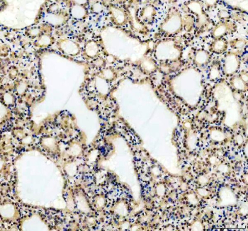 IHC analysis of UBXN1 in human thyroid cancer tissue. Paraffin-embedded human thyroid cancer tissue was analyzed for UBXN1 expression by immunohistochemistry. Heat-mediated antigen retrieval was performed in EDTA buffer (pH 8.0), and sections were blocked with 10% goat serum prior to incubation with a rabbit anti-UBXN1 antibody overnight at 4Â°C. Detection was performed using an HRP-conjugated secondary antibody with DAB chromogen, followed by hematoxylin counterstaining. UBXN1 shows cytoplasmic staining within tumor cells.