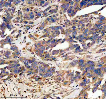 Immunohistochemistry analysis of Platelet-derived growth factor D using PDGF-D antibody.Platelet-derived growth factor D expression was examined in a paraffin-embedded section of human ovarian cancer tissue. Heat-mediated antigen retrieval was performed using EDTA buffer (pH 8.0). Tissue sections were blocked with normal goat serum and incubated with PDGF-D antibody overnight at 4C. Immunoreactivity was visualized using an HRP-based detection system with DAB chromogen, followed by hematoxylin counterstaining.