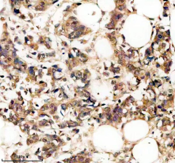 Immunohistochemistry analysis of Protein pelota homolog using PELO antibody. PELO expression was examined in a paraffin-embedded section of human breast cancer tissue. Heat-mediated antigen retrieval was performed using EDTA buffer (pH 8.0). Tissue sections were blocked with normal goat serum and incubated with PELO antibody overnight at 4C. Immunoreactivity is observed within tumor epithelial cells, consistent with cytoplasmic localization, with variable staining intensity across the tumor field. Detection was visualized using an HRP-based detection system with DAB chromogen, followed by hematoxylin counterstaining.