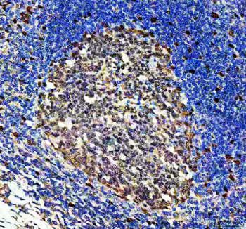 DUT Antibody Human Tonsil Germinal Center IHC. Immunohistochemistry staining of FFPE human tonsil using DUT antibody demonstrates prominent nuclear staining within germinal center lymphocytes, consistent with the expected localization of Deoxyuridine Triphosphatase (DUT). DUT is a genome integrity enzyme that maintains nucleotide pool balance and prevents inappropriate uracil incorporation into DNA during replication. The strong nuclear staining observed within actively proliferating lymphoid cells is consistent with increased demand for nucleotide metabolism and DNA replication fidelity in germinal center reactions. Variable staining intensity among cellular populations reflects differences in proliferative activity and supports the utility of this antibody for studies of genome maintenance, cellular proliferation, and DNA integrity pathways. HIER: heat-mediated antigen retrieval in EDTA buffer (pH 8.0).