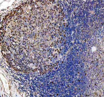 DUT Antibody Human Tonsil IHC. Immunohistochemistry staining of FFPE human tonsil using DUT antibody demonstrates widespread nuclear staining throughout lymphoid compartments, with particularly prominent immunoreactivity within germinal center-associated cell populations. DUT (Deoxyuridine Triphosphatase) is a genome integrity enzyme that regulates intracellular nucleotide pools and protects DNA from inappropriate uracil incorporation during replication. The broad nuclear staining pattern observed across proliferative immune cell populations is consistent with the established role of DUT in supporting DNA replication fidelity, genome maintenance, and cellular proliferation. These findings support the utility of DUT antibody for studies of nucleotide metabolism, DNA integrity pathways, and lymphoid tissue biology. HIER: heat-mediated antigen retrieval in EDTA buffer (pH 8.0).