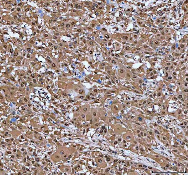 IRF3 Antibody Human Bladder Cancer IHC. Immunohistochemical staining of FFPE human bladder urothelial carcinoma tissue with IRF3 antibody at 2 ug/ml. Heat-induced epitope retrieval (HIER) was performed by boiling tissue sections in pH 8 EDTA buffer prior to staining. IRF3 immunoreactivity is observed predominantly within the cytoplasm of malignant urothelial cells, consistent with the expected localization of this innate immune transcription factor, which undergoes phosphorylation-dependent nuclear translocation to activate type I interferon signaling and antiviral gene expression. Cell nuclei are counterstained with hematoxylin (blue).