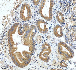 Inverted Formin 2 Antibody Human Stomach Cancer IHC. Immunohistochemistry staining of FFPE human stomach cancer tissue with Inverted Formin 2 Antibody at 2 ug/ml. HIER was performed using pH 8 EDTA buffer, followed by blocking with 10% goat serum. The tissue section was incubated with rabbit anti-INF2 antibody overnight at 4Â°C, followed by HRP-conjugated goat anti-rabbit IgG secondary antibody and DAB chromogen detection. Inverted Formin 2 Antibody / Formin Protein Antibody demonstrates cytoplasmic staining consistent with INF2 expression and supports studies of actin cytoskeleton remodeling, intracellular organization and cell structure regulation pathways.