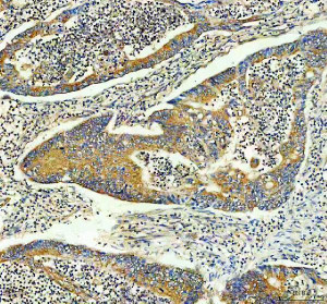 Inverted Formin 2 Antibody Human Colon Cancer IHC. Immunohistochemistry staining of FFPE human colon cancer tissue with Inverted Formin 2 Antibody at 2 ug/ml. HIER was performed using pH 8 EDTA buffer, followed by blocking with 10% goat serum. The tissue section was incubated with rabbit anti-INF2 antibody overnight at 4Â°C, followed by HRP-conjugated goat anti-rabbit IgG secondary antibody and DAB chromogen detection. Inverted Formin 2 Antibody / Formin Protein Antibody demonstrates cytoplasmic staining consistent with INF2 expression and supports studies of actin cytoskeleton remodeling, intracellular organization and formin-mediated cellular regulation pathways.
