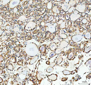 Inverted Formin 2 Antibody Human Thyroid Cancer IHC. Immunohistochemistry staining of FFPE human thyroid cancer tissue with Inverted Formin 2 Antibody at 2 ug/ml. HIER was performed using pH 8 EDTA buffer, followed by blocking with 10% goat serum. The tissue section was incubated with rabbit anti-INF2 antibody overnight at 4Â°C, followed by HRP-conjugated goat anti-rabbit IgG secondary antibody and DAB chromogen detection. Inverted Formin 2 Antibody / Formin Protein Antibody demonstrates cytoplasmic staining consistent with INF2 expression and supports studies of actin cytoskeleton remodeling, intracellular organization and formin-mediated cellular regulation pathways.