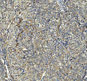 PIST Antibody / Golgi Trafficking Protein Antibody Human Hepatocellular Carcinoma IHC. Immunohistochemistry analysis of FFPE human hepatocellular carcinoma tissue using PIST Antibody / Golgi Trafficking Protein Antibody. Heat mediated antigen retrieval was performed using pH 8 EDTA buffer, and the tissue section was incubated with the primary antibody at 2 ug/ml overnight at 4Â°C. HRP-conjugated secondary antibody and DAB substrate were used for detection. Strong cytoplasmic staining is observed throughout malignant hepatocytes, supporting the use of PIST Antibody / Golgi Trafficking Protein Antibody for studying Golgi trafficking protein expression and intracellular transport pathways in cancer biology research.