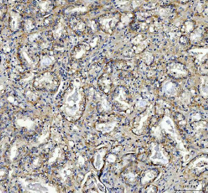 PIST Antibody / Golgi Trafficking Protein Antibody Human Prostate Cancer IHC. Immunohistochemistry analysis of FFPE human prostatic acinar adenocarcinoma tissue using PIST Antibody / Golgi Trafficking Protein Antibody. Heat mediated antigen retrieval was performed using pH 8 EDTA buffer, and the tissue section was incubated with the primary antibody at 2 ug/ml overnight at 4Â°C. HRP-conjugated secondary antibody and DAB substrate were used for detection. Cytoplasmic staining is observed in malignant prostate epithelial cells, supporting the use of PIST Antibody / Golgi Trafficking Protein Antibody for studying Golgi trafficking protein expression, vesicle transport and intracellular protein sorting pathways in cancer research.