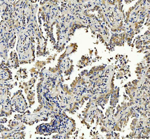 PIST Antibody / Golgi Trafficking Protein Antibody Human Lung Cancer IHC. Immunohistochemistry analysis of FFPE human lung cancer tissue using PIST Antibody / Golgi Trafficking Protein Antibody. Heat mediated antigen retrieval was performed using pH 8 EDTA buffer, and the tissue section was incubated with the primary antibody at 2 ug/ml overnight at 4Â°C. HRP-conjugated secondary antibody and DAB substrate were used for detection. Distinct cytoplasmic staining is observed in malignant epithelial cells, supporting the use of PIST Antibody / Golgi Trafficking Protein Antibody for evaluating Golgi trafficking protein expression, receptor sorting and intracellular transport pathways in tumor biology research.