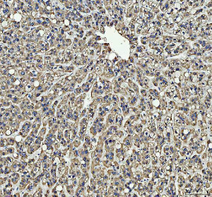 PIST Antibody / Golgi Trafficking Protein Antibody Human Liver Cancer IHC. Immunohistochemistry analysis of FFPE human liver cancer tissue using PIST Antibody / Golgi Trafficking Protein Antibody. Heat mediated antigen retrieval was performed using pH 8 EDTA buffer, and the tissue section was incubated with the primary antibody at 2 ug/ml overnight at 4Â°C. HRP-conjugated secondary antibody and DAB substrate were used for detection. Strong cytoplasmic staining is observed in tumor cells, supporting the use of PIST Antibody / Golgi Trafficking Protein Antibody for studying Golgi trafficking protein expression and intracellular protein sorting pathways in cancer research.