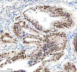KLF5 Antibody Human Colon Cancer IHC. Immunohistochemical analysis of FFPE human colon cancer tissue using KLF5 Antibody. Heat-induced epitope retrieval was performed in pH 8.0 EDTA buffer prior to incubation with the primary antibody at 2 ug/mL overnight at 4Â°C. An HRP-conjugated goat anti-rabbit secondary antibody with DAB chromogen was used for visualization. Strong nuclear staining is observed in the neoplastic glandular epithelial cells, with minimal cytoplasmic immunoreactivity, consistent with the expected localization of the KLF5 transcription factor. These results demonstrate that KLF5 Antibody, an Epithelial Transcription Factor Antibody, specifically detects endogenous KLF5 in FFPE human colon cancer tissue.