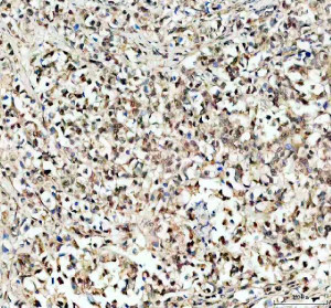 KLF5 Antibody Human Stomach Cancer IHC. Immunohistochemical analysis of FFPE human stomach cancer tissue using KLF5 Antibody. Heat-induced epitope retrieval was performed in pH 8.0 EDTA buffer prior to incubation with the primary antibody at 2 ug/mL overnight at 4Â°C. An HRP-conjugated goat anti-rabbit secondary antibody with DAB chromogen was used for visualization. Predominantly nuclear staining with variable cytoplasmic immunoreactivity is observed in the gastric carcinoma cells, consistent with the expected localization of the KLF5 transcription factor. These results demonstrate that KLF5 Antibody, an Epithelial Transcription Factor Antibody, specifically detects endogenous KLF5 in FFPE human cancer tissue.
