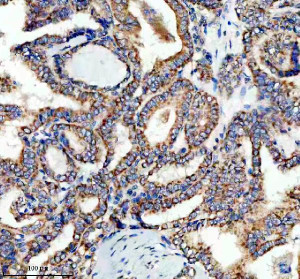 LARS2 Antibody Human Thyroid Cancer IHC. Immunohistochemical analysis of FFPE human thyroid cancer tissue using LARS2 Antibody. Heat-induced epitope retrieval was performed in pH 8.0 EDTA buffer prior to incubation with the primary antibody at 2 ug/mL overnight at 4Â°C. An HRP-conjugated goat anti-rabbit secondary antibody with DAB chromogen was used for visualization. Strong granular cytoplasmic staining is observed throughout the neoplastic thyroid epithelial cells, consistent with the expected mitochondrial localization of leucyl-tRNA synthetase 2. These results demonstrate that LARS2 Antibody, a Mitochondrial Leucyl-tRNA Synthetase Antibody, specifically detects endogenous LARS2 in FFPE human thyroid cancer tissue.