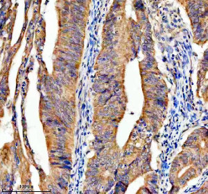 LARS2 Antibody Human Colon Cancer IHC. Immunohistochemical analysis of FFPE human colon cancer tissue using LARS2 Antibody. Heat-induced epitope retrieval was performed in pH 8.0 EDTA buffer prior to incubation with the primary antibody at 2 ug/mL overnight at 4Â°C. An HRP-conjugated goat anti-rabbit secondary antibody with DAB chromogen was used for visualization. Strong diffuse granular cytoplasmic staining is observed throughout the neoplastic glandular epithelial cells, consistent with the expected mitochondrial localization of leucyl-tRNA synthetase 2. These results demonstrate that LARS2 Antibody, a Mitochondrial Leucyl-tRNA Synthetase Antibody, specifically detects endogenous LARS2 in FFPE human colon cancer tissue.