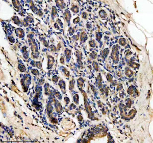 LARS2 Antibody Human Breast Cancer IHC. Immunohistochemical analysis of FFPE human breast cancer tissue using LARS2 Antibody. Heat-induced epitope retrieval was performed in pH 8.0 EDTA buffer prior to incubation with the primary antibody at 2 ug/mL overnight at 4Â°C. An HRP-conjugated goat anti-rabbit secondary antibody with DAB chromogen was used for visualization. Moderate granular cytoplasmic staining is observed throughout the neoplastic epithelial cells, consistent with the expected mitochondrial localization of leucyl-tRNA synthetase 2. These results demonstrate that LARS2 Antibody, a Mitochondrial Leucyl-tRNA Synthetase Antibody, specifically detects endogenous LARS2 in FFPE human breast cancer tissue.