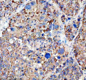 LARS2 Antibody Human Liver Cancer IHC. Immunohistochemical analysis of FFPE human liver cancer tissue using LARS2 Antibody. Heat-induced epitope retrieval was performed in pH 8.0 EDTA buffer prior to incubation with the primary antibody at 2 ug/mL overnight at 4Â°C. An HRP-conjugated goat anti-rabbit secondary antibody with DAB chromogen was used for visualization. Moderate to strong granular cytoplasmic staining is observed throughout the tumor cells, consistent with the expected mitochondrial localization of leucyl-tRNA synthetase 2. These results demonstrate that LARS2 Antibody, a Mitochondrial Leucyl-tRNA Synthetase Antibody, specifically detects endogenous LARS2 in FFPE human liver cancer tissue.