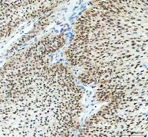 ELAVL1 Antibody Human Ovarian Cancer IHC. Immunohistochemical analysis of FFPE human ovarian cancer tissue using ELAVL1 Antibody. Heat-induced epitope retrieval was performed in pH 8.0 EDTA buffer prior to incubation with the primary antibody (1:100) overnight at 4Â°C. An HRP-conjugated goat anti-rabbit secondary antibody with DAB chromogen was used for visualization. Strong, widespread nuclear staining is observed throughout the tumor cells with only limited cytoplasmic immunoreactivity, consistent with the predominant nuclear localization of ELAVL1 under basal conditions. These results demonstrate that ELAVL1 Antibody, an ELAV Like RNA Binding Protein 1 Antibody, specifically detects endogenous ELAVL1 in FFPE human ovarian cancer tissue.