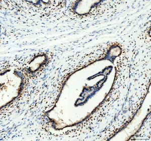 ELAVL1 Antibody Human Breast Cancer IHC. Immunohistochemical analysis of FFPE human breast cancer tissue using ELAVL1 Antibody. Heat-induced epitope retrieval was performed in pH 8.0 EDTA buffer prior to incubation with the primary antibody (1:100) overnight at 4Â°C. An HRP-conjugated goat anti-rabbit secondary antibody with DAB chromogen was used for visualization. Distinct nuclear staining with additional cytoplasmic immunoreactivity is observed in the neoplastic epithelial cells, consistent with the characteristic subcellular distribution of ELAVL1 and its regulated nucleocytoplasmic shuttling. These results demonstrate that ELAVL1 Antibody, an ELAV Like RNA Binding Protein 1 Antibody, specifically detects endogenous ELAVL1 in FFPE human breast cancer tissue.