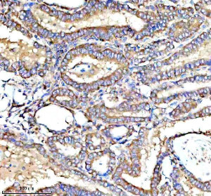 RPS12 Antibody Human Thyroid Cancer IHC. Immunohistochemical analysis of FFPE human thyroid cancer tissue using RPS12 Antibody. Heat-induced epitope retrieval was performed in pH 8.0 EDTA buffer prior to incubation with the primary antibody (1:100) overnight at 4Â°C. An HRP-conjugated goat anti-rabbit secondary antibody with DAB chromogen was used for visualization. Moderate to strong diffuse cytoplasmic staining is observed throughout the neoplastic thyroid epithelial cells, consistent with the expected cytoplasmic localization of the 40S ribosomal protein S12 within actively translating ribosomes. These results demonstrate that RPS12 Antibody, a 40S Ribosomal Protein S12 Antibody, specifically detects endogenous RPS12 in FFPE human thyroid cancer tissue.