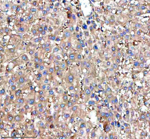 RPS12 Antibody Human Liver Cancer IHC. Immunohistochemical analysis of FFPE human liver cancer tissue using RPS12 Antibody. Heat-induced epitope retrieval was performed in pH 8.0 EDTA buffer prior to incubation with the primary antibody (1:100) overnight at 4Â°C. An HRP-conjugated goat anti-rabbit secondary antibody with DAB chromogen was used for visualization. Moderate diffuse cytoplasmic staining is observed throughout the hepatocellular tumor cells, consistent with the expected cytoplasmic localization of 40S ribosomal protein S12 within actively translating ribosomes. These results demonstrate that RPS12 Antibody, a 40S Ribosomal Protein S12 Antibody, specifically detects endogenous RPS12 in FFPE human liver cancer tissue.