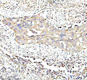 RPS12 Antibody Human Bladder Cancer IHC. Immunohistochemical analysis of FFPE human bladder cancer tissue using RPS12 Antibody. Heat-induced epitope retrieval was performed in pH 8.0 EDTA buffer prior to incubation with the primary antibody (1:100) overnight at 4Â°C. An HRP-conjugated goat anti-rabbit secondary antibody with DAB chromogen was used for visualization. Moderate diffuse cytoplasmic staining is observed within the neoplastic urothelial cells, consistent with the expected cytoplasmic localization of 40S ribosomal protein S12 as a component of actively translating ribosomes. These results demonstrate that RPS12 Antibody, a 40S Ribosomal Protein S12 Antibody, specifically detects endogenous RPS12 in FFPE human bladder cancer tissue.