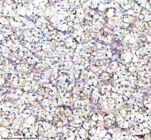 RPS12 Antibody Human Clear Cell Renal Cell Carcinoma IHC. Immunohistochemical analysis of FFPE human clear cell renal cell carcinoma tissue using RPS12 Antibody. Heat-induced epitope retrieval was performed in pH 8.0 EDTA buffer prior to incubation with the primary antibody (1:100) overnight at 4Â°C. An HRP-conjugated goat anti-rabbit secondary antibody with DAB chromogen was used for visualization. Diffuse cytoplasmic staining is observed throughout the clear cell renal carcinoma cells, consistent with the expected cytoplasmic localization of 40S ribosomal protein S12 within actively translating ribosomes. These results demonstrate that RPS12 Antibody, a 40S Ribosomal Protein S12 Antibody, specifically detects endogenous RPS12 in FFPE human clear cell renal cell carcinoma tissue.