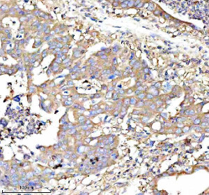 RPS12 Antibody Human Rectal Cancer IHC. Immunohistochemical analysis of FFPE human rectal cancer tissue using RPS12 Antibody. Heat-induced epitope retrieval was performed in pH 8.0 EDTA buffer prior to incubation with the primary antibody (1:100) overnight at 4Â°C. An HRP-conjugated goat anti-rabbit secondary antibody with DAB chromogen was used for visualization. Moderate to strong diffuse cytoplasmic staining is observed throughout the neoplastic epithelial cells, consistent with the expected cytoplasmic localization of 40S ribosomal protein S12 within actively translating ribosomes. These results demonstrate that RPS12 Antibody, a 40S Ribosomal Protein S12 Antibody, specifically detects endogenous RPS12 in FFPE human rectal cancer tissue.