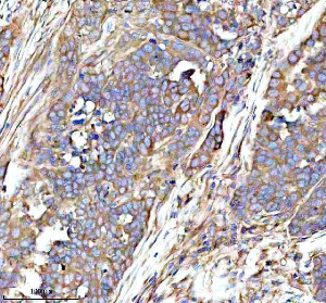 RPS12 Antibody Human Ovarian Cancer IHC. Immunohistochemical analysis of FFPE human ovarian cancer tissue using RPS12 Antibody. Heat-induced epitope retrieval was performed in pH 8.0 EDTA buffer prior to incubation with the primary antibody (1:100) overnight at 4Â°C. An HRP-conjugated goat anti-rabbit secondary antibody with DAB chromogen was used for visualization. Moderate to strong diffuse cytoplasmic staining is observed throughout the neoplastic ovarian epithelial cells, consistent with the expected cytoplasmic localization of 40S ribosomal protein S12 within actively translating ribosomes. These results demonstrate that RPS12 Antibody, a 40S Ribosomal Protein S12 Antibody, specifically detects endogenous RPS12 in FFPE human ovarian cancer tissue.