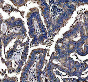 CEP55 Antibody Human Colon Cancer IHC. Immunohistochemical staining of FFPE human colon cancer tissue using CEP55 antibody at 2 ug/ml following heat-induced epitope retrieval in pH8 EDTA buffer. Detection was performed using an HRP-conjugated secondary antibody with DAB chromogen. CEP55 immunoreactivity is observed predominantly within the cytoplasm of malignant epithelial cells, with widespread staining throughout the tumor tissue, consistent with the elevated expression of this cytokinesis regulator frequently reported in proliferating cancer cells. This result demonstrates that the CEP55 Antibody / Cytokinesis Protein Antibody is suitable for immunohistochemical detection of endogenous CEP55 in formalin-fixed, paraffin-embedded human tissues.