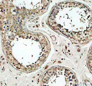CEP55 Antibody Human Testicular Cancer IHC. Immunohistochemical staining of FFPE human testicular cancer tissue using CEP55 antibody at 2 ug/ml following heat-induced epitope retrieval in pH8 EDTA buffer. Detection was performed using an HRP-conjugated secondary antibody with DAB chromogen. CEP55 immunoreactivity is observed predominantly within the cytoplasm of tumor cells, with widespread staining throughout the neoplastic tissue, consistent with the increased expression of this cytokinesis regulator in actively proliferating cells. This result demonstrates that the CEP55 Antibody / Cytokinesis Protein Antibody is suitable for immunohistochemical detection of endogenous CEP55 in formalin-fixed, paraffin-embedded human tissues.