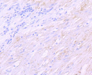 SGCD Antibody Human Stomach Carcinoma IHC. Immunohistochemical analysis of FFPE human stomach carcinoma tissue using SGCD Antibody / Sarcoglycan Family Protein Antibody, clone AbS97. Heat-induced epitope retrieval was performed in Tris-EDTA buffer (pH 8.0-8.4) for 20 minutes. The recombinant rabbit monoclonal antibody was applied at a 1:100 dilution, and staining was visualized using an HRP polymer detection system with DAB chromogen. Membranous and cytoplasmic staining is observed within the tumor tissue, consistent with SGCD expression, while hematoxylin provides nuclear counterstaining. This SGCD Antibody, also called Sarcoglycan Family Protein Antibody, is suitable for studies of sarcoglycan biology, muscle membrane stability, dystrophin-associated protein complexes, and skeletal and cardiac muscle physiology.