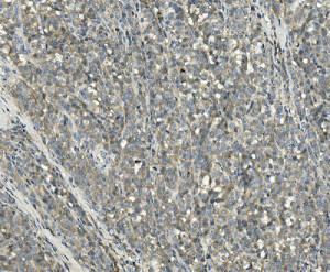 PPM1E Antibody Human Melanoma IHC. Immunohistochemical staining of FFPE human melanoma tissue using PPM1E Antibody / Protein Phosphatase 1E Antibody. Heat-induced epitope retrieval was performed in pH 8.0 EDTA buffer before incubation with PPM1E Antibody at 1 ug/ml. A biotinylated goat anti-rabbit secondary antibody with an SABC detection system and DAB chromogen was used for visualization. PPM1E exhibits predominantly cytoplasmic staining in melanoma cells, consistent with its role as a PP2C family serine/threonine phosphatase that regulates phosphorylation-dependent signaling pathways. This PPM1E Antibody, also called Protein Phosphatase 1E Antibody, is suitable for studies of protein dephosphorylation, MAPK signaling, neuronal signaling, and cancer-associated signal transduction.